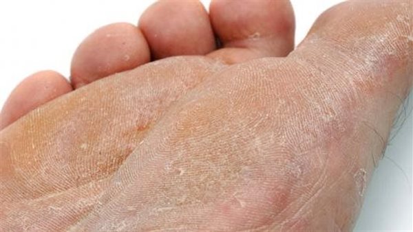 سعفة القدم (أرشيفية)