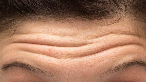 علاجات طبيعية لخطوط