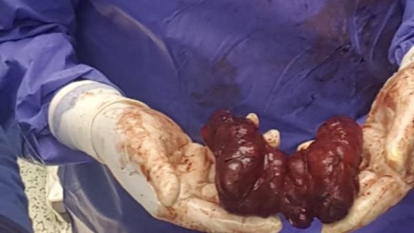 استئصال ورم ضخم من