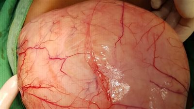 نجاح عملية نادرة لاستئصال ورم خُلقي وزنه 3 كيلو من بطن طفل بالإسكندرية