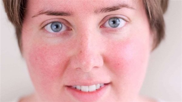 احمرار الوجه أو حالة