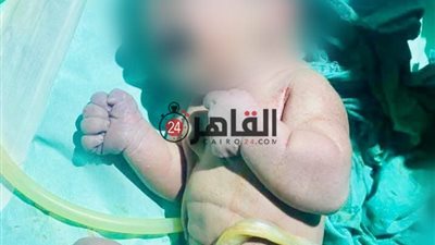 طفل على هيئة حورية البحر.. الأقصر تشهد ولادة نادرة