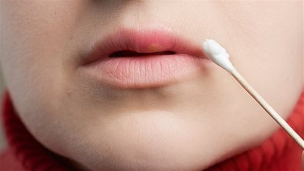 المسحة الجلدية لفيروس