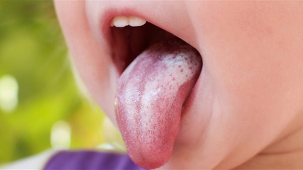  فطريات الفم