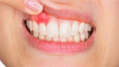 ألم اللثة والأسنان يزيدان من خطر الإصابة بالسرطان بنسبة 75% | دراسة