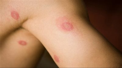 ما هي الأمراض التي تسببها الفطريات؟ 