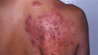 تعرف على أفضل علاج لمرض الهربس وأنواعه ومضاعفاته 