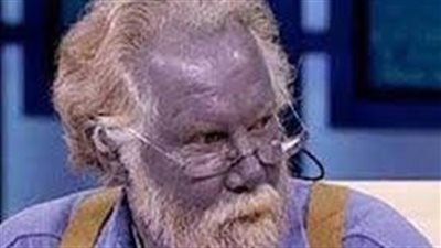 تعرف على أغرب الأمراض في العالم وأسمائها 