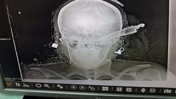 أشعة سيدة مضروبة