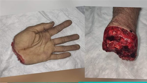 يد نجار مبتورة بالكامل