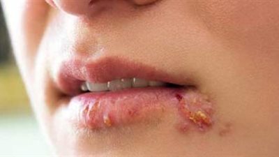 أفضل علاج لمرض الهربس