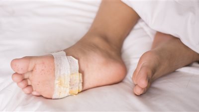 خبراء يكشفون العلاقة بين العناية بالأقدام والإصابة بالمرض السكري