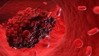 هل هناك طريقة لرصد تجلط الدم لدى المتلقين للقاح كورونا؟