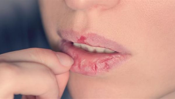 تشقق الشفاه