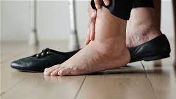 احتباس الماء