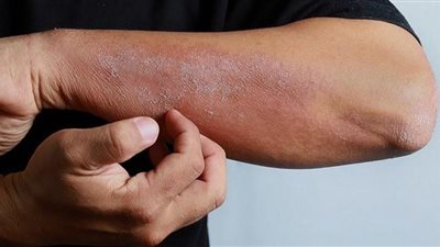 يسبب الطفح الجلدي.. تعرف على اضرار‎