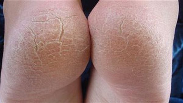 تشققات كعب القدم