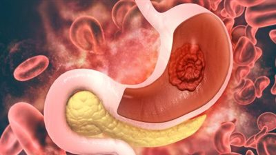 تعرف على أعراض وعلاج سرطان المعدة
