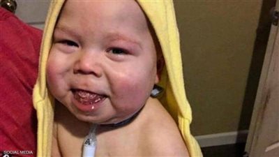 مرض نادر يتسبب في قطع لسان رضيع بعد ولادته بعام