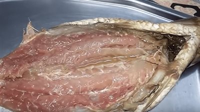 180 ألف جنيه تكلفة علاج حالتين تسمم من الفسيخ بالإسكندرية