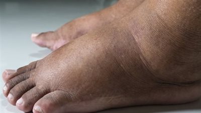 أسباب تورم القدمين وطرق تجنب تلك المشكلة
