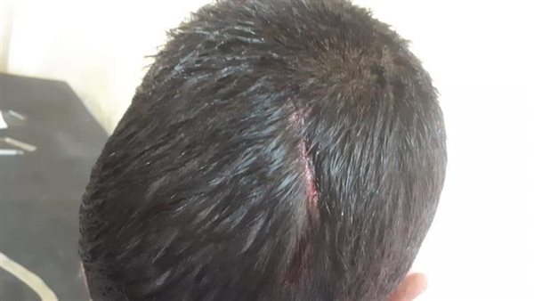 الطفل المصاب