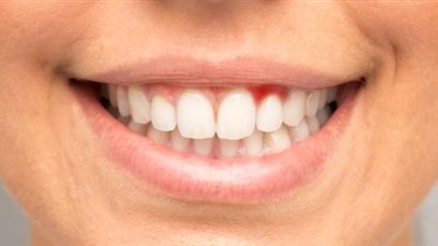 دراسة: كيف يؤدي تلف اللثة إلى الإصابة بفيروس كورونا