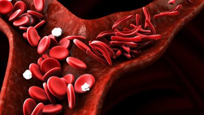 إذا كنت تعاني من فقر الدم.. إليك تلك النصائح في رمضان‎