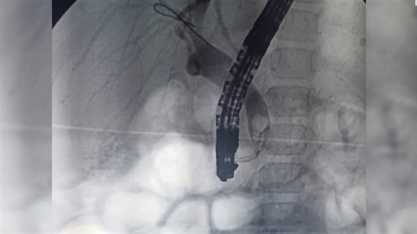 الدعامة البلاستيكية