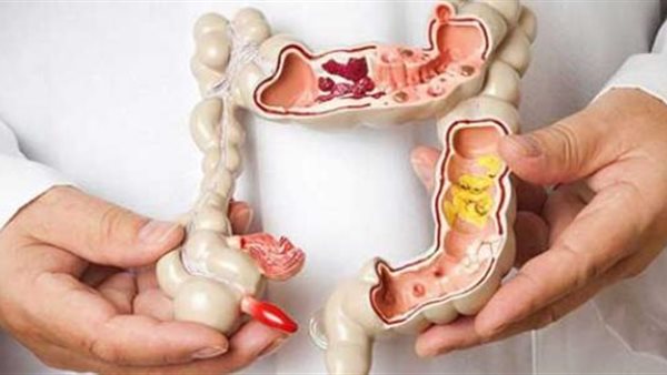 سرطان الأمعاء