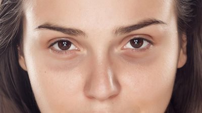 عن طريق عصير البطاطس.. طريقة للقضاء على الهالات السوداء