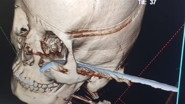 استخراج سيخ حديدي