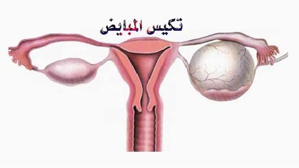 تكيس المبايض
