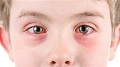 ما هي هي أهم أعراض حساسية العين عند الأطفال؟