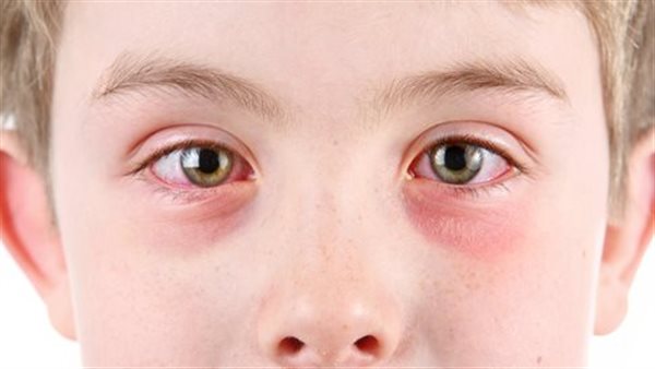 حساسية العين عند