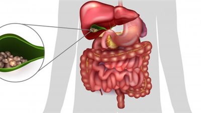 تفاصيل نجاح أول جراحة روبوتية لاستئصال المرارة في مصر