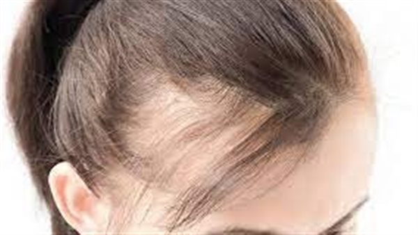 علاج تساقط الشعر