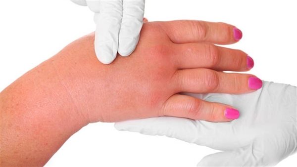 احتباس المياه في