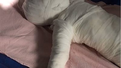 مصرع طفلة سقط عليها إناء مغلى فى سوهاج  