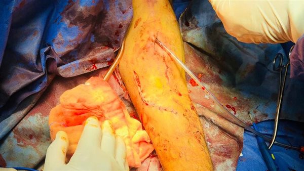 استئصال تمدد شرياني