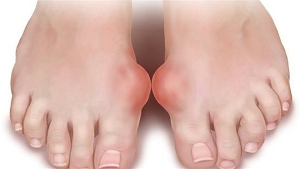 الإصابة بالنقرس 