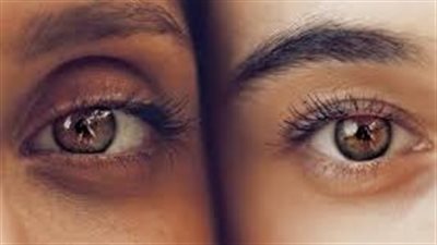 تعرف على أفضل علاج للهالات السوداء بالليزر