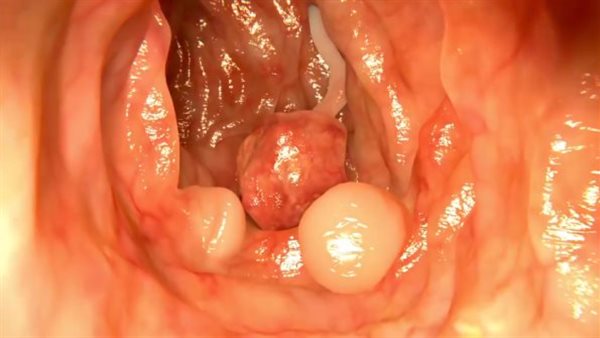 الإصابة بسرطان القولون