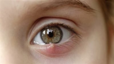 شعيرة العين.. مرض مؤلم يمكن علاجه بوصفات طبيعية
