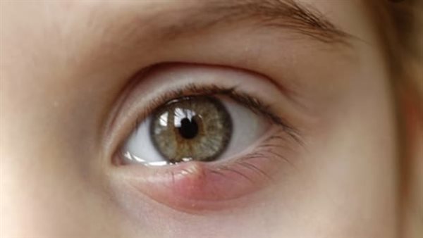 شعيرة العين