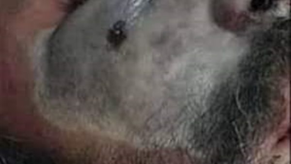 مرض الفطر الأسود