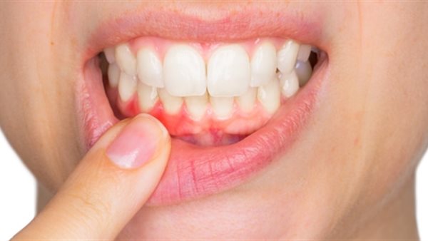 التهاب اللثة 