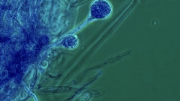 مرض الفطر الأسود