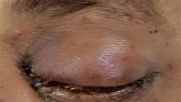 المريض المشتبه في