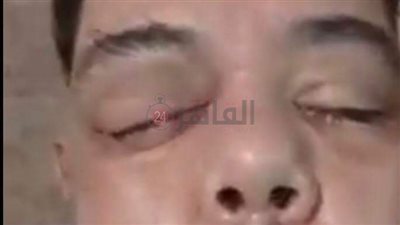 الصحة تُعلن تخصيص غرف عزل لمرضى الفطر الأسود بالشرقية (خاص)